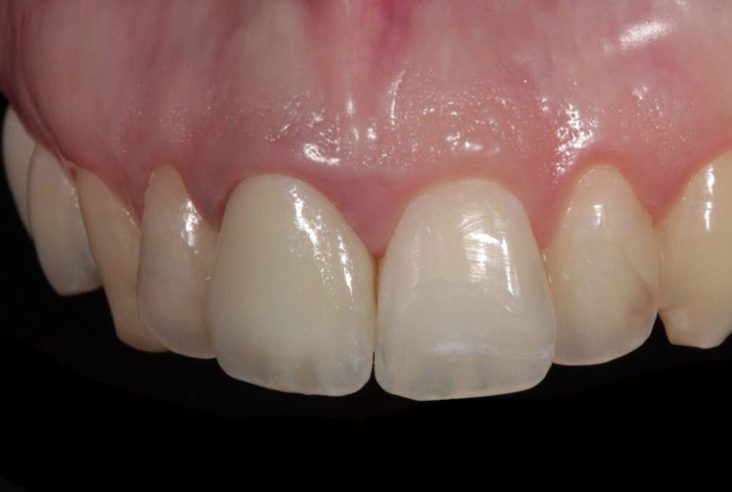 Imagen de unaprótesis dental de cerámica de primera calidad.