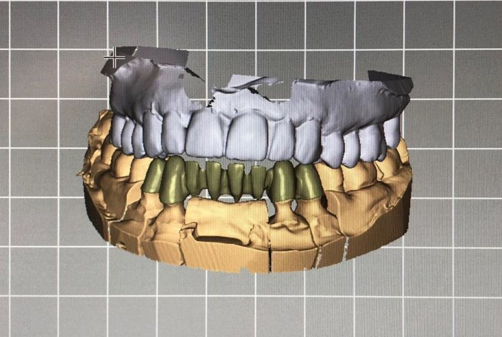 Captura de pantalla del diseño de prótesis dentales con tecnología CAD/CAM.