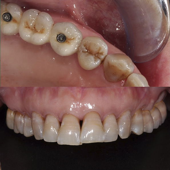 Imagen del caso clínico de modificación del aspecto de dientes amarillos por tetraciclina.